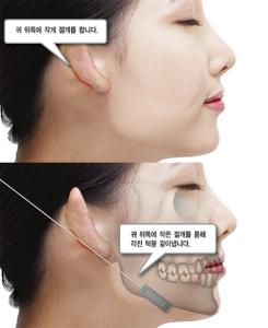 下颌角的角度标准 下颌角 下颌角-相关知识，下颌角-美学标准
