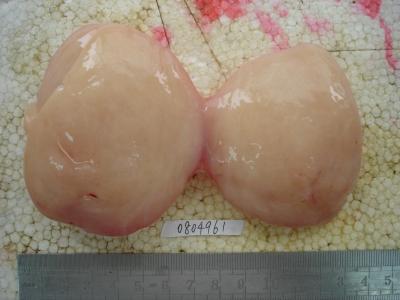 脂肪肉瘤 脂肪肉瘤-概述，脂肪肉瘤-流行病学