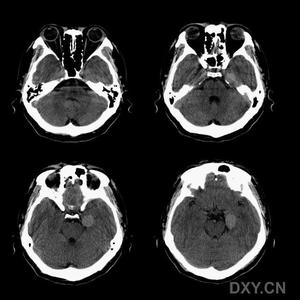 血酮正常值及临床意义 脑CT 脑CT-脑CT的正常值，脑CT-脑CT的临床意义