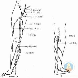 下肢静脉曲张 下肢静脉曲张-病理概述，下肢静脉曲张-病理病因