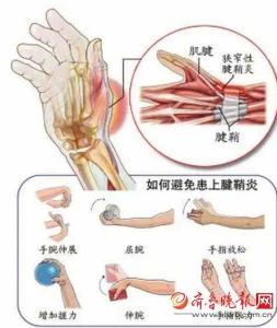 手腕腱鞘炎 手腕腱鞘炎-基本简介，手腕腱鞘炎-发病原因