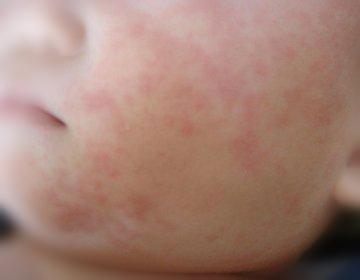 幼儿急疹 幼儿急疹-发病机理，幼儿急疹-临床表现