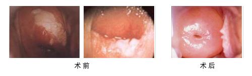 宫颈白斑 宫颈白斑-病因，宫颈白斑-临床表现