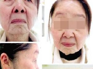 获得性面部皮肤衰老症 获得性面部皮肤衰老症-概述，获得性面部皮