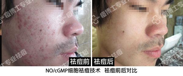 痘印的形成原因 痘印 痘印-形成,痘印-痘痕痘印产生的原因