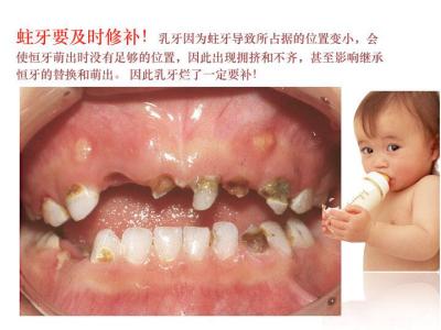 乳牙滞留 乳牙滞留-发病病因，乳牙滞留-临床表现