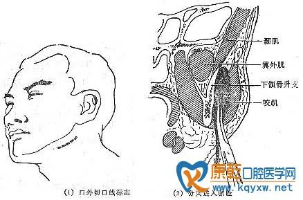 咬肌间隙感染 咬肌间隙 咬肌间隙-简介，咬肌间隙-总结