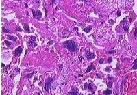 绒毛膜癌 绒毛膜癌-基本概述，绒毛膜癌-病因病机