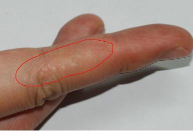 水疱型手癣 水疱型手癣-症状，水疱型手癣-药物治疗