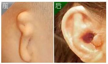 耳再造 全耳再造术 全耳再造术-概述，全耳再造术-术前准备