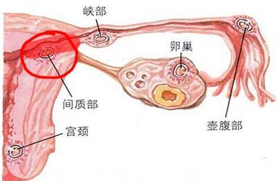 慢性输卵管炎 慢性输卵管炎 慢性输卵管炎-病因，慢性输卵管炎-病理