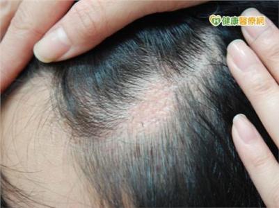 植发疤痕多少钱 疤痕植发 疤痕植发-常见疤痕植发类型，疤痕植发-疤痕植发主流技
