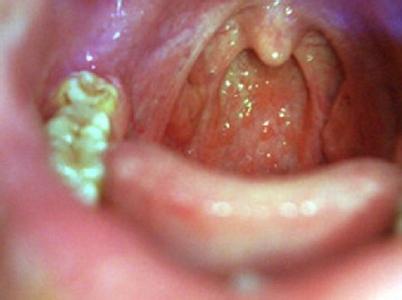 咽喉炎最佳治疗方法 咽炎治疗方法中哪种效果最好呢