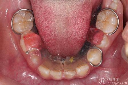 前牙深覆盖 前牙深覆盖-病因，前牙深覆盖-并发病症