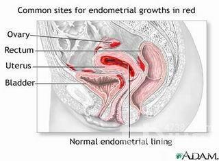卵巢黄体囊肿破裂 卵巢黄体囊肿破裂-概述，卵巢黄体囊肿破裂-病