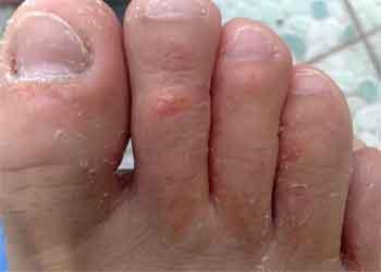 水疱型脚气 水疱型脚气-病因，水疱型脚气-治疗