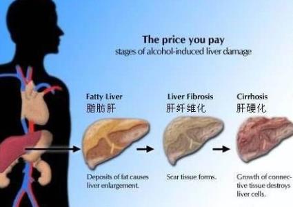中度脂肪肝 中度脂肪肝-病因介绍，中度脂肪肝-症状