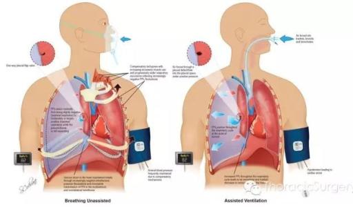 自发性气胸 自发性气胸-临床表现，自发性气胸-诊断依据