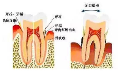 牙齿松动等级 牙齿松动的原因是什么