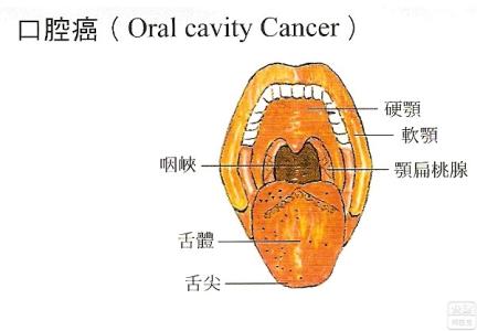 口腔癌 口腔癌-概述，口腔癌-病因