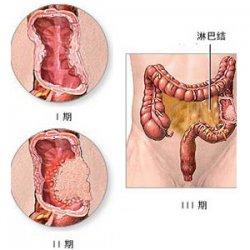 肠子癌的症状是什么 慢性结肠炎的症状是什么