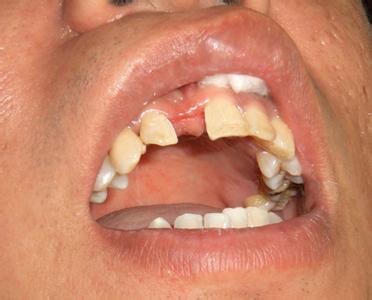 隐形义齿的优缺点 隐形义齿 隐形义齿-隐形义齿，隐形义齿-物品优点