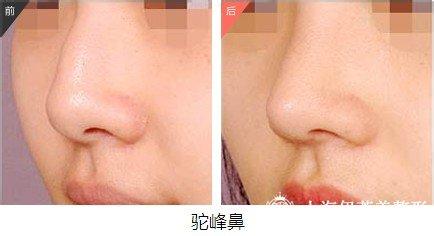 驼峰鼻矫正术 驼峰鼻矫正术-概述，驼峰鼻矫正术-分型