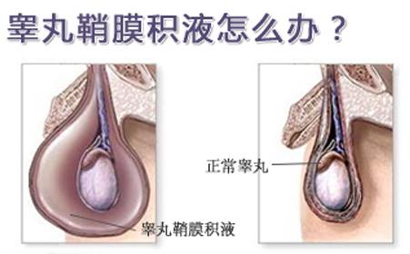 左侧睾丸鞘膜积液 睾丸鞘膜积液 睾丸鞘膜积液-疾病定义，睾丸鞘膜积液-疾病病理