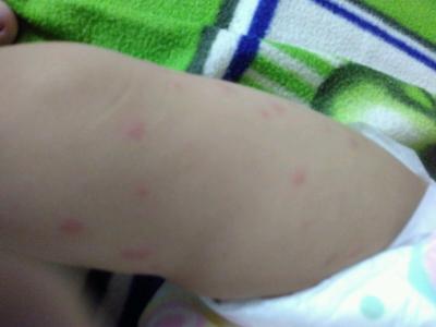 小儿荨麻疹 小儿荨麻疹-病因，小儿荨麻疹-临床表现