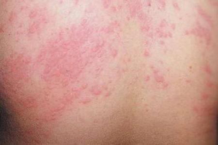 皮肤过敏症状荨麻疹 皮肤过敏症状 得了荨麻疹后有哪些症状?