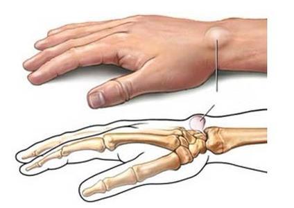 腱鞘囊肿的病因 手腕腱鞘囊肿 手腕腱鞘囊肿-概述，手腕腱鞘囊肿-疾病病因