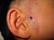 耳前瘘管的治疗方法 耳前瘘管 耳前瘘管-基本内容，耳前瘘管-治疗方法