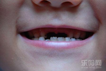 蛀牙的危害 蛀牙 蛀牙-种类，蛀牙-危害