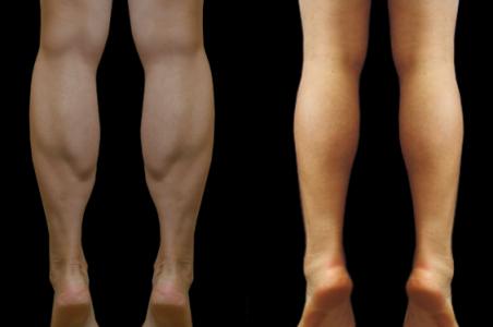 小腿肌肉手术 瘦小腿手术 瘦小腿手术-手术原因，瘦小腿手术-肌肉类型