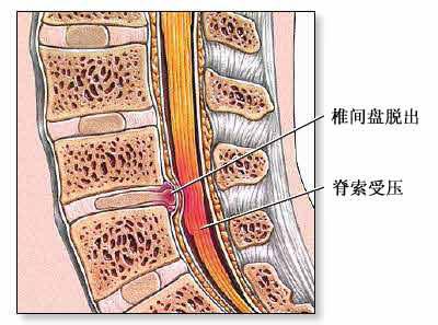 子宫肌瘤手术指征 手术指征 手术指征-基本内容