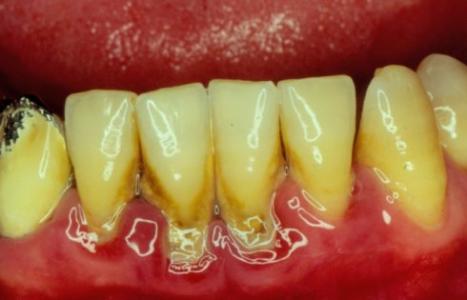 牙结石形成原因 牙结石 牙结石-疾病概述，牙结石-形成原因
