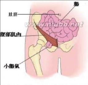 腹股沟疝的临床表现 腹股沟疝 腹股沟疝-病理病因，腹股沟疝-临床表现