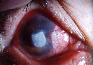 传染性角膜炎 传染性角膜炎 传染性角膜炎-病因，传染性角膜炎-症状表现