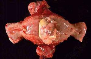 子宫内膜间质肉瘤分期 子宫肉瘤 子宫肉瘤-概述，子宫肉瘤-临床分期