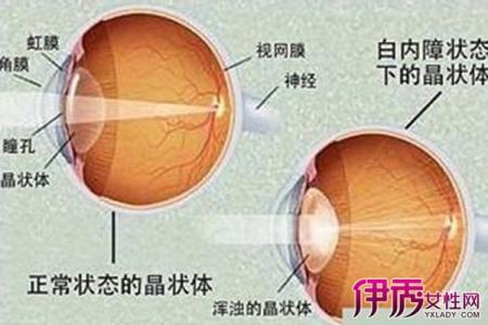 白内障的早期症状 白内障早期治疗方法