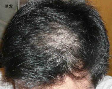 脂溢性脱发是什么原因 脱发原因是什么？