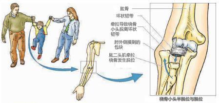 肩关节脱位的临床表现 肘关节脱位 肘关节脱位-病因，肘关节脱位-临床表现