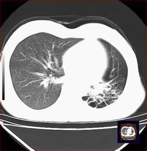 肺纤维化的病因有哪些 肺纤维化 肺纤维化-概述，肺纤维化-病因