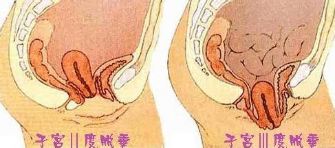 子宫下垂的原因 子宫下垂 子宫下垂-子宫下垂简介，子宫下垂-子宫下垂的原因