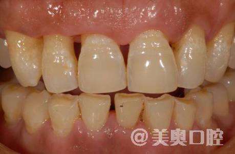 牙齿松动分度 牙齿松动 牙齿松动-临床分度，牙齿松动-概述