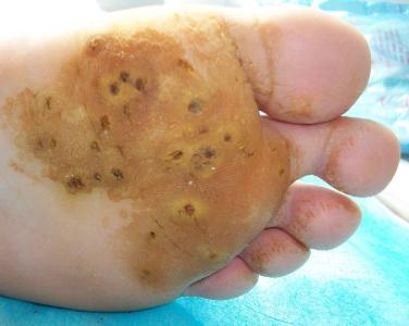 急性湿疹的临床特点 跖疣 跖疣-简介，跖疣-临床特点