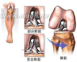 膝关节韧带损伤检查 韧带损伤 韧带损伤-病因，韧带损伤-检查