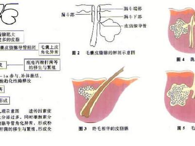 痘痘形成的原因 细讲痘痘形成的原因