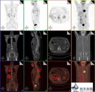 肺癌骨转移症状 肺癌骨转移 肺癌骨转移-症状，肺癌骨转移-诊断