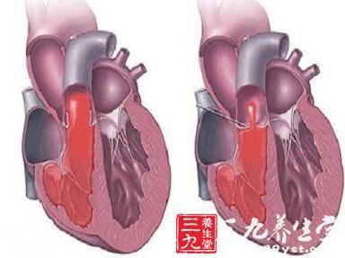 原发性心脏肿瘤 原发性心脏肿瘤 原发性心脏肿瘤-临床表现，原发性心脏肿瘤-流行